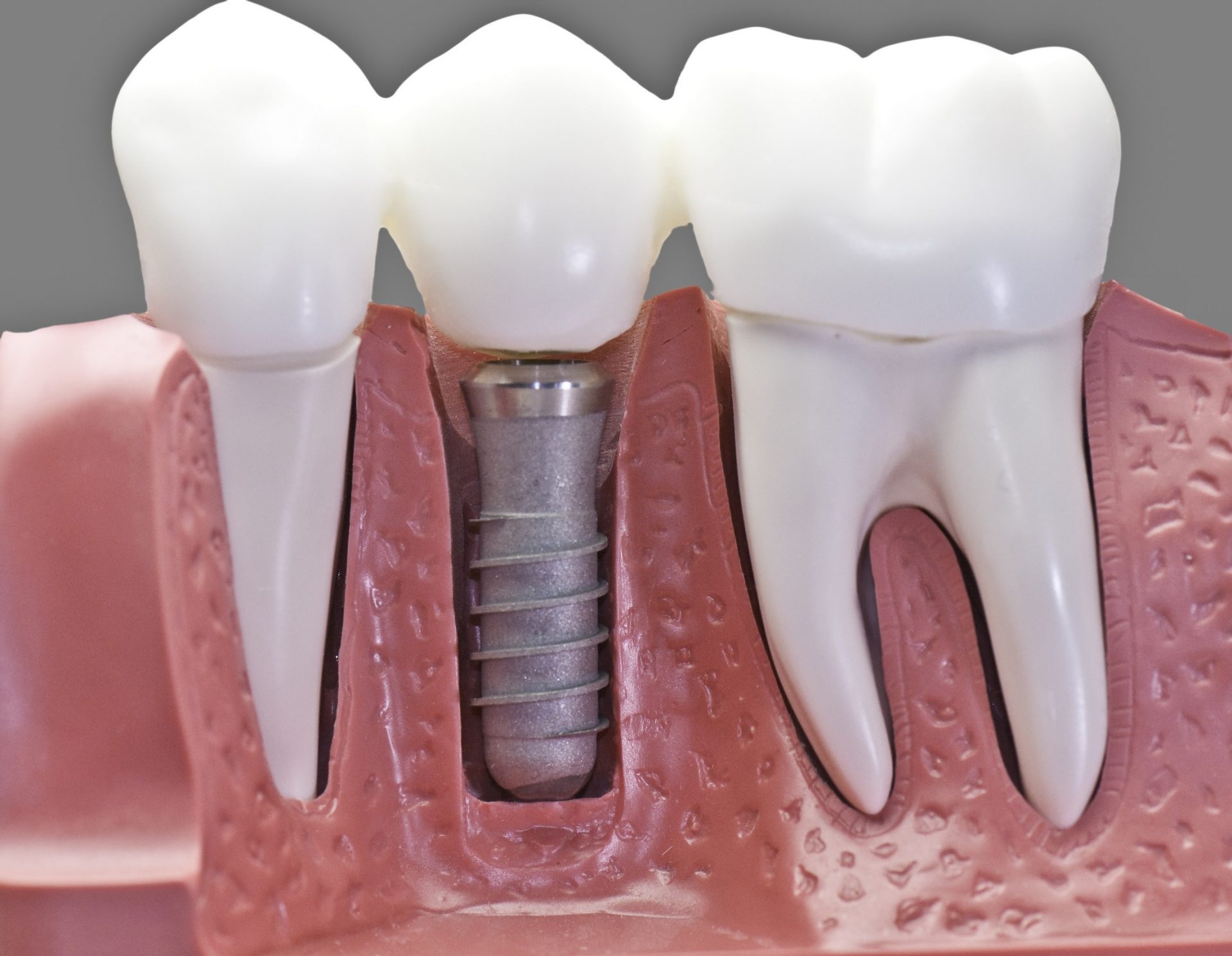 https://luminousdentacare.com/wp-content/uploads/2022/03/single-dental-implant.jpeg
